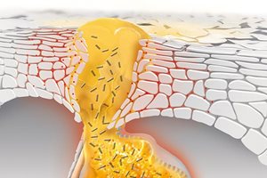 What causes blackheads, whiteheads and pimples and how does acne develop