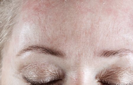 Woman´s scaly forehead